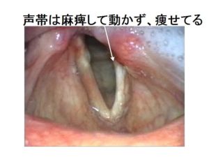 声帯ポリープ 癌 症状
